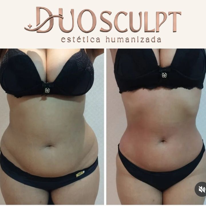 reducao de gordura sorocaba