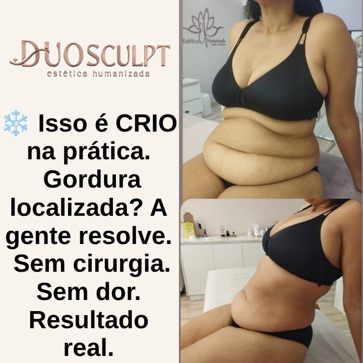 criolipolese sorocaba